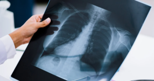 Doctor holding chest xray